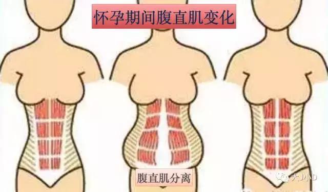 你的腹直肌分離了嗎？