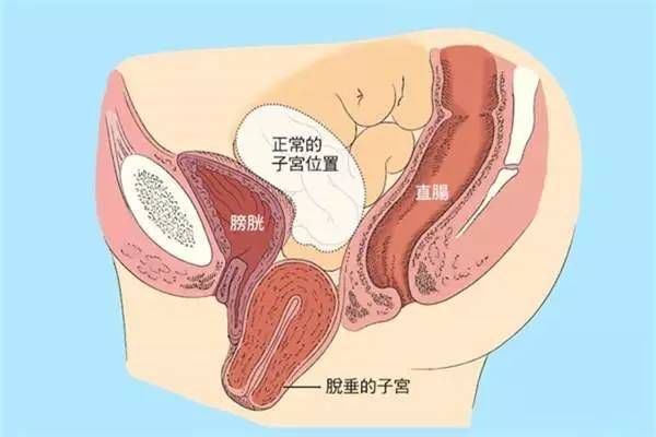 【產(chǎn)后修復(fù)】盆腔臟器脫垂，你有嗎？