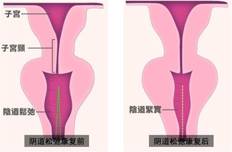 【盆底肌修復(fù)】盆底不修復(fù)，老來后患無窮