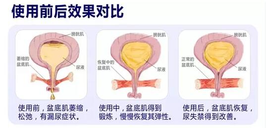 盆底康復(fù)治療怎么做？產(chǎn)后盆底功能檢測(cè)很重要