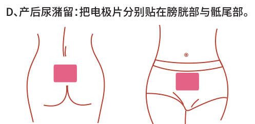 產(chǎn)后康復(fù)治療儀/仿生物電刺激治療產(chǎn)后尿潴留效果怎么樣？
