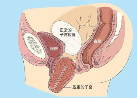 人們常說，產(chǎn)后女性做好盆底肌修復(fù)是關(guān)鍵，但盆腔器官的脫垂你也得注意