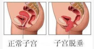 產(chǎn)后恢復(fù)，盆底肌修復(fù)的功能障礙