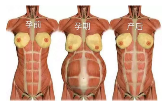 產婦不要隨意大吃大喝，腹直肌分離修復不太容易