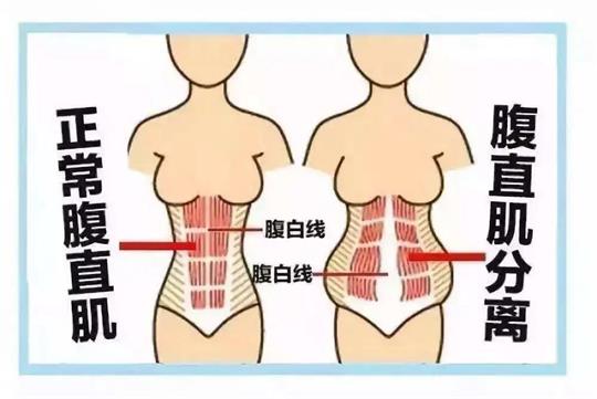 你所不知道的產(chǎn)后腹直肌如何康復(fù)，通澤產(chǎn)康為您解答