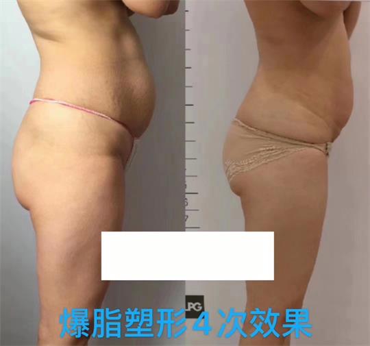 產(chǎn)后塑形美雕儀，生完孩子真的很難恢復(fù)身材？未必……