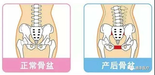 產(chǎn)后康復(fù)儀器能對(duì)骨盆產(chǎn)生康復(fù)鞏固作用嗎？答案肯定是可以的