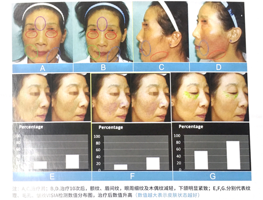 速get8D多極射頻美雕儀，保持年輕體態(tài)的好產(chǎn)品