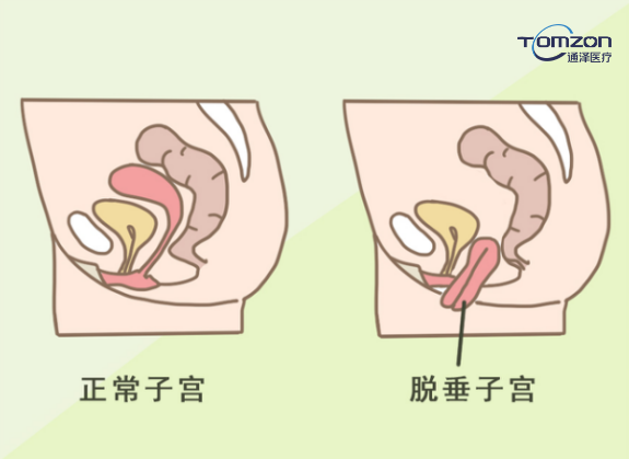 你害怕子宮脫垂嗎？盆底肌修復(fù)儀器來拯救你