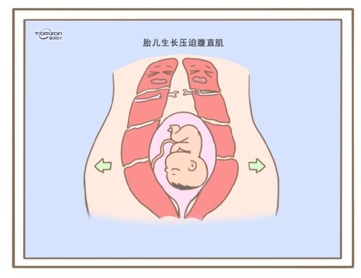 腹直肌分離可以使用盆底肌修復(fù)儀器嗎？